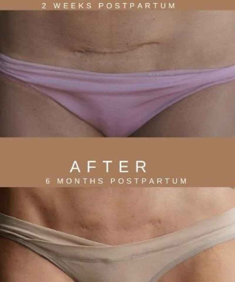 Restorative Scar Treatment (Nemah)